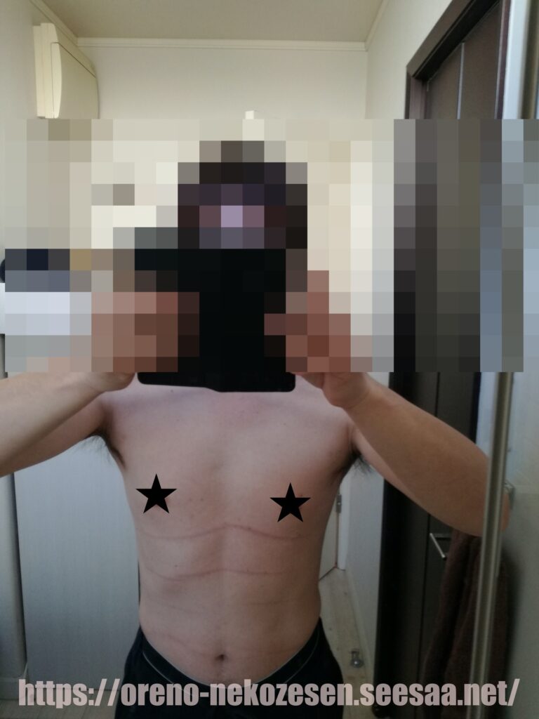 妊娠線クリーム使用前の猫背線の写真